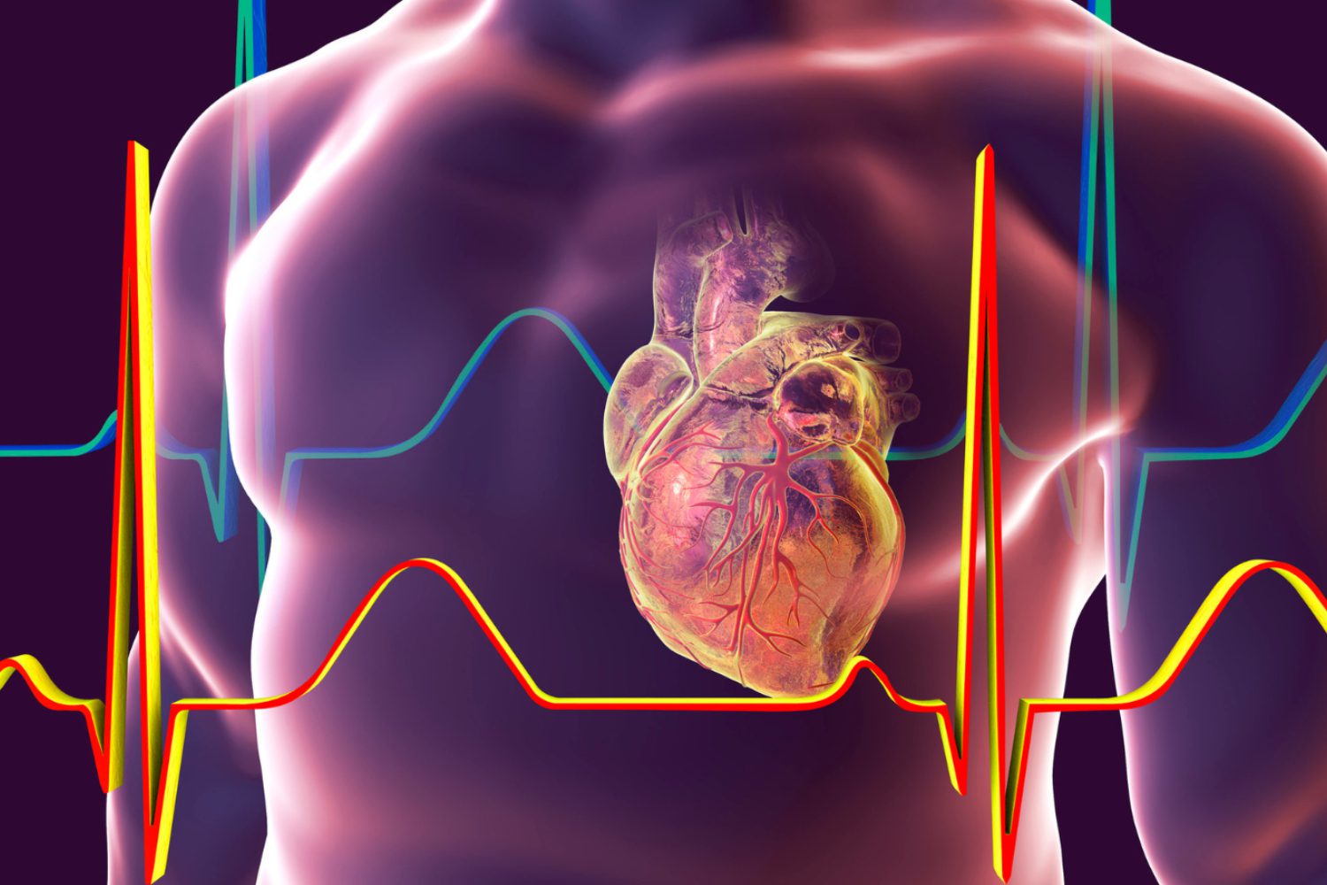 ECG NYMVC ECG NYMVC